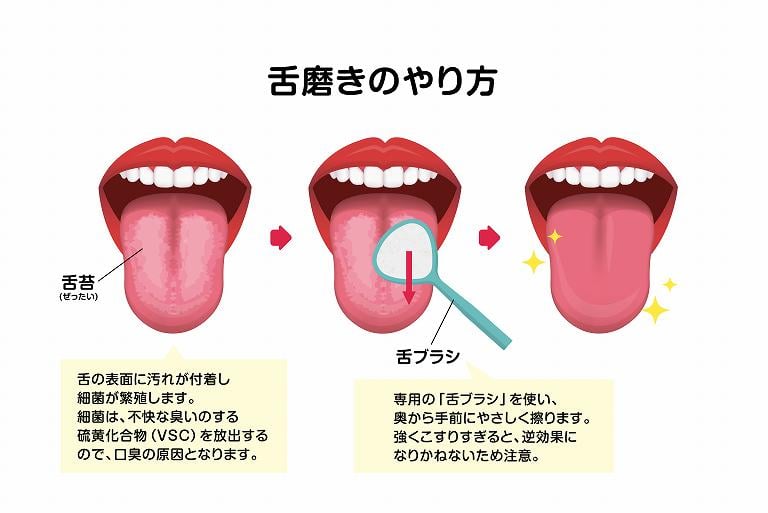 舌磨きによる舌苔の取り方